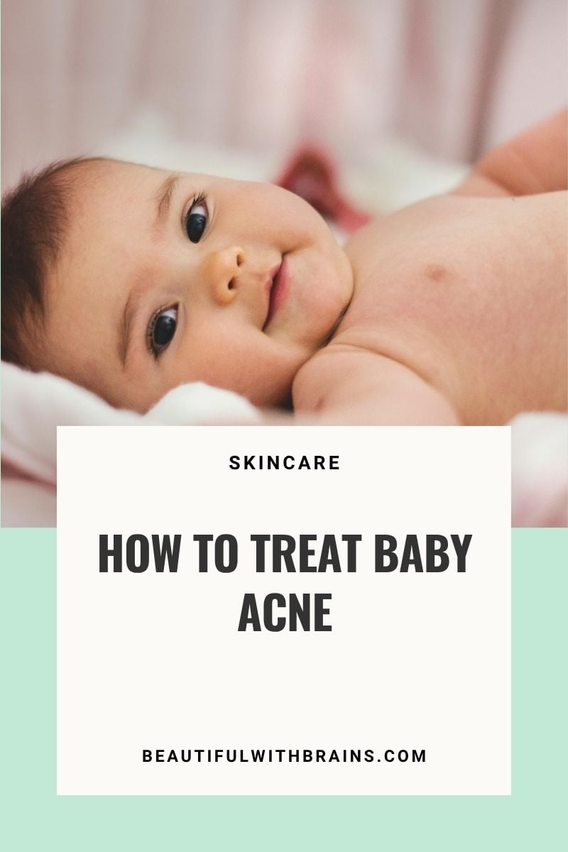 How To Treat Baby Acne