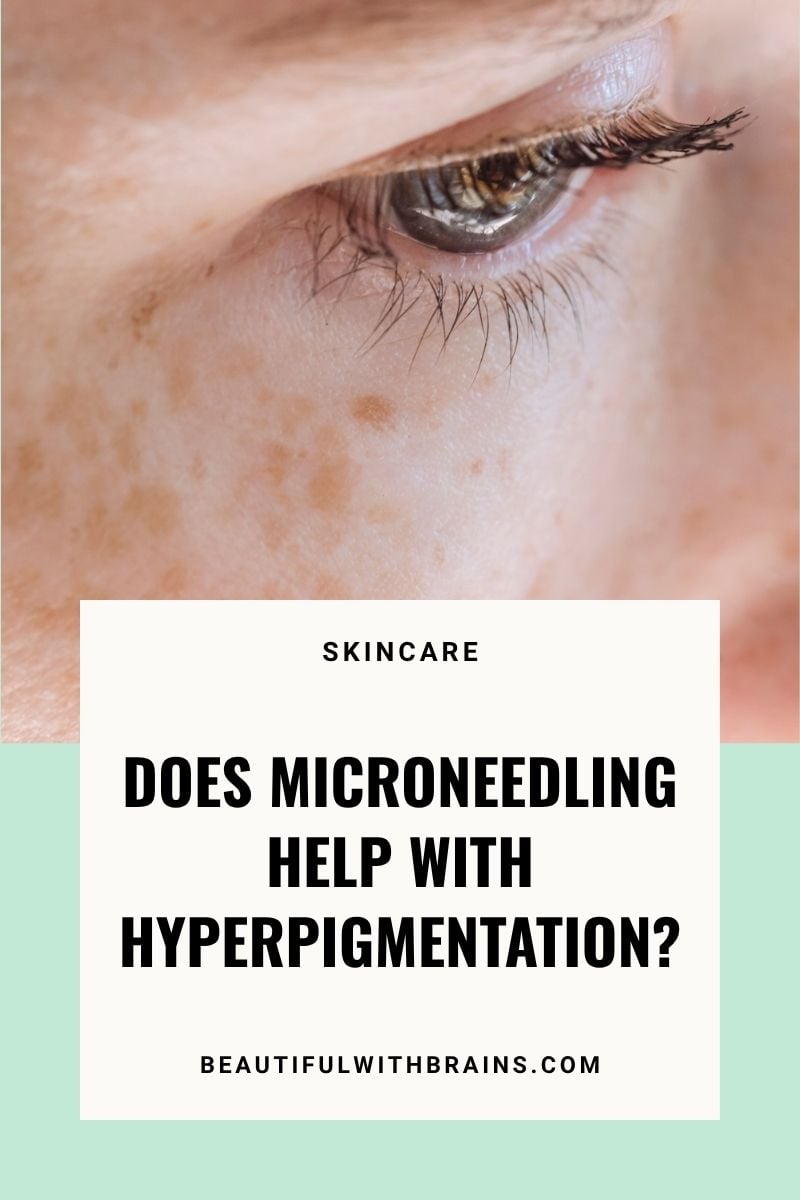 does microneedling help with hyperpigmentation