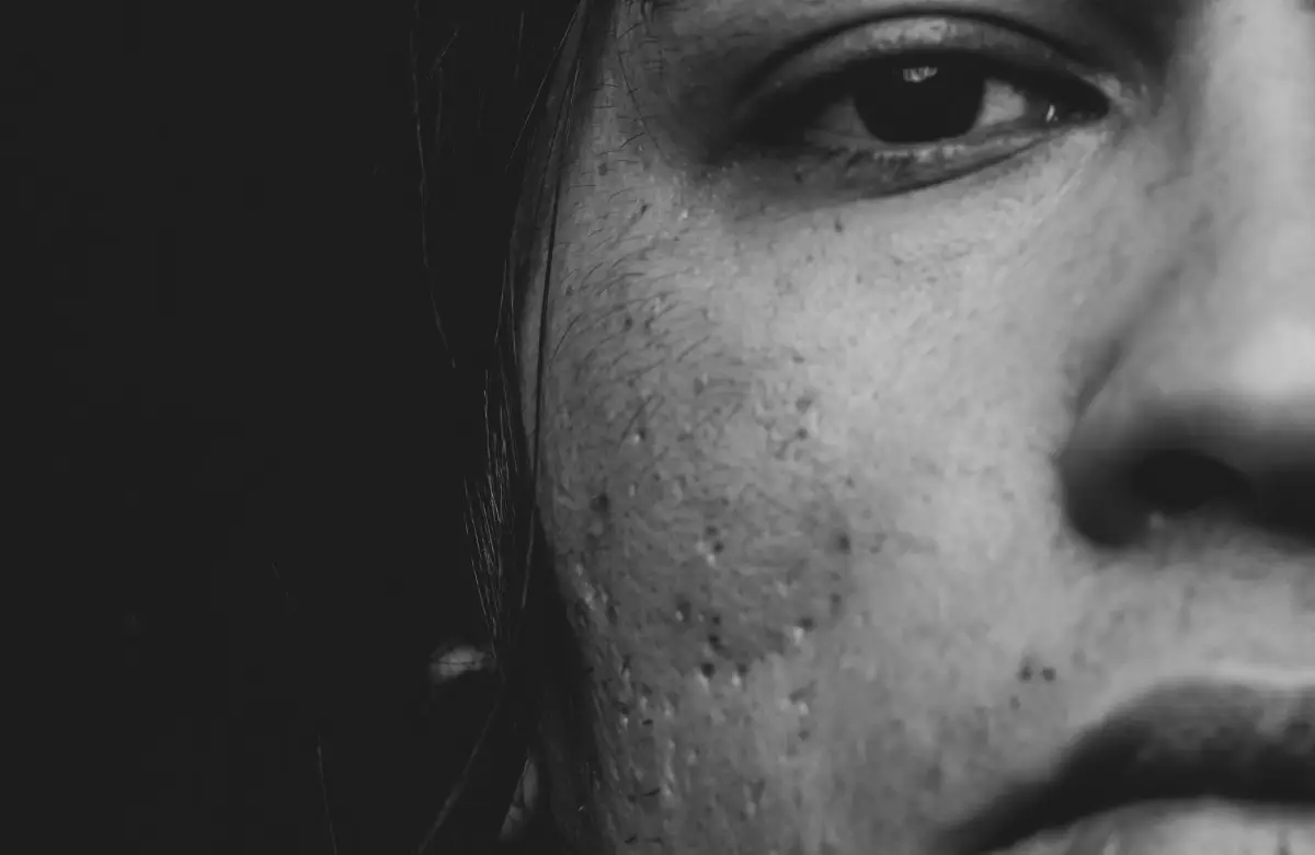 adapalene for acne scars